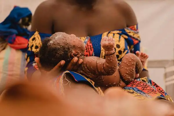 Un año de la emergencia internacional por mpox