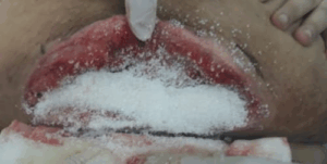 La sorprendente capacidad del azúcar para ayudar a curar heridas