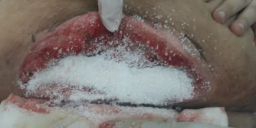 La sorprendente capacidad del azúcar para ayudar a curar heridas