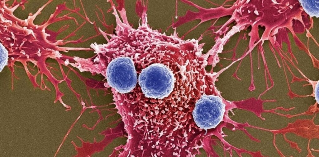 ¡Según estudio! el antioxidante glutatión nutre a las células cancerosas